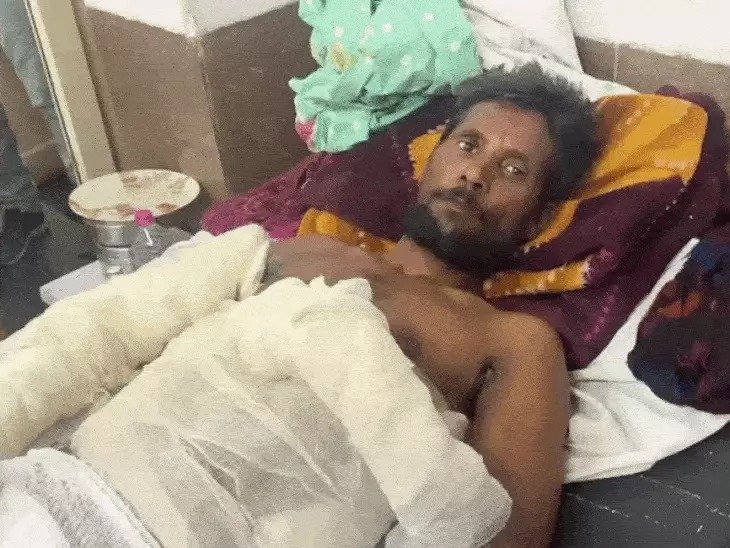 Rewa News: रीवा में बिजली लाइन सुधारते समय बड़ा हादसा, आउटसोर्स लाइनमैन गंभीर रूप से झुलसा